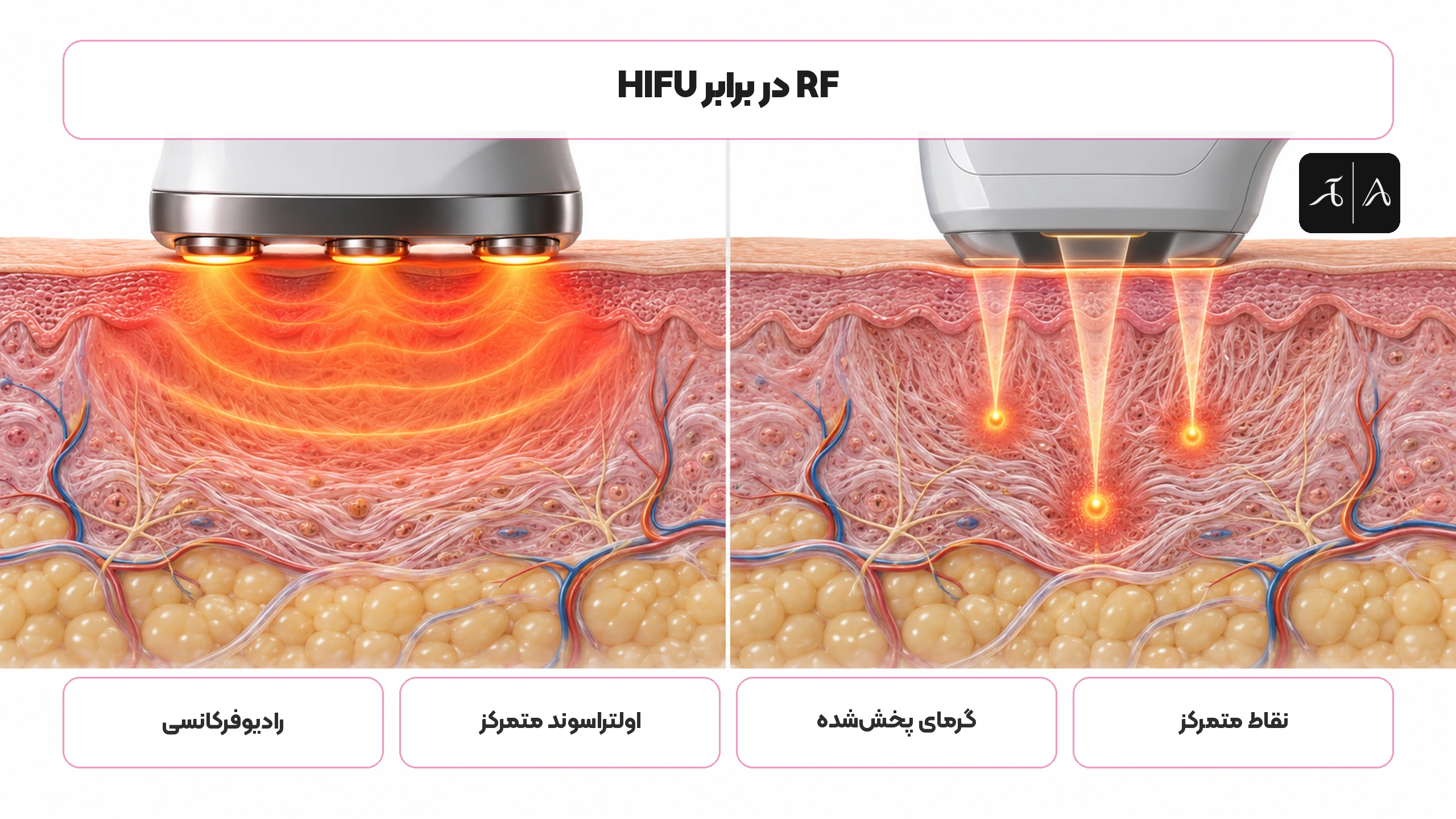 تفاوت انرژی RF و HIFU در پوست صورت