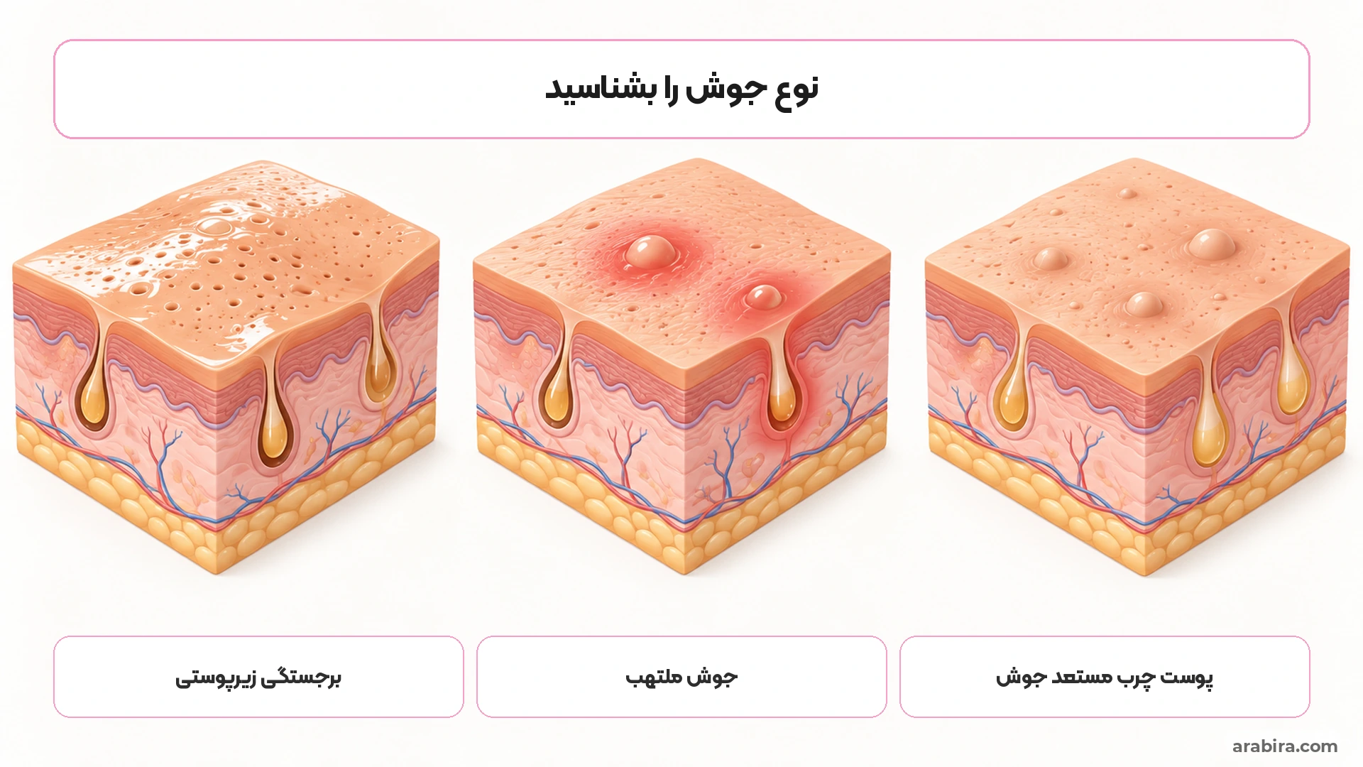 اینفوگرافیک تصویری تفاوت جوش زیرپوستی، جوش قرمز التهابی و پوست چرب مستعد جوش